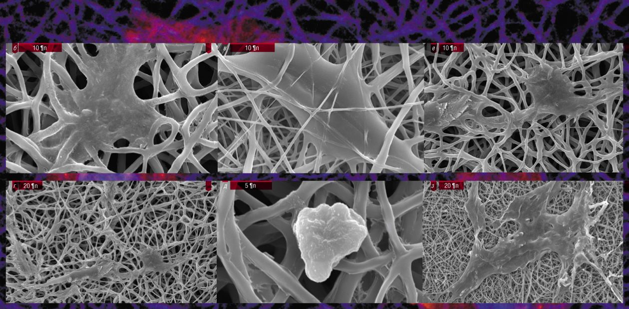 Tissue Engineering: A 3D Angioplasty