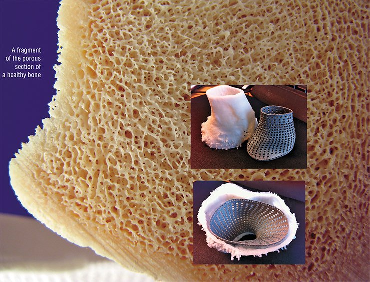 This protective mesh structure made in the EBM machine protects the bone of the real patient from the stress caused by sitting in its hip stem implant. The bones were so weakened by osteoporosis that without the protective cage the loads transferred by the hip implant would have easily destroyed them completely This protective mesh structure made in the EBM machine protects the bone of the real patient from the stress caused by sitting in its hip stem implant. The bones were so weakened by osteoporosis that without the protective cage the loads transferred by the hip implant would have easily destroyed them completely
