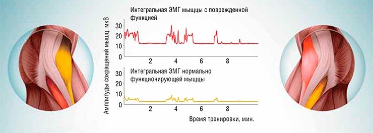 Во время тренинга биоуправления динамика поврежденных функций сравнивается с сохраненными, например, сравниваются электромиография (ЭМГ) симметричных мыщц, полученная по двум каналам