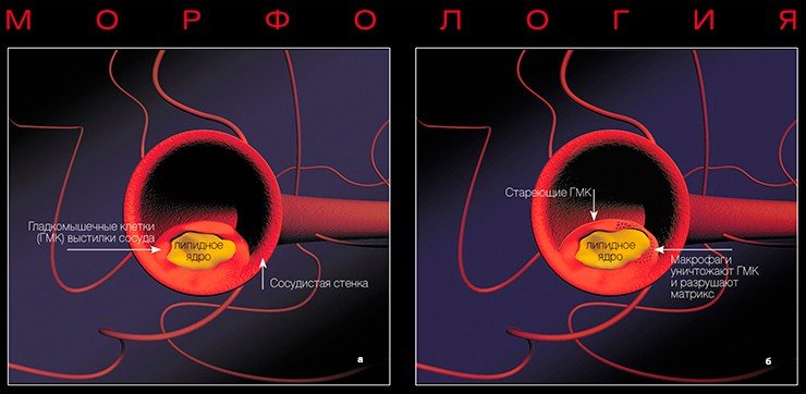 Атеросклеротические бляшки – морфологические «носители» атеросклероза – проходят в своем развитии ряд последовательных стадий: а – на ранних этапах формирования склеротические бляшки содержат большое количество липидов и имеют тонкую соединительнотканную капсулу. Их называют ранимыми, или желтыми бляшками; б – тонкая соединительнотканная оболочка желтых бляшек может быть повреждена как в связи с воздействием гемодинамических факторов (перепады давления в сосуде, сужение и растяжение стенки), так и в результате того, что содержащиеся вблизи оболочки клетки иммунной системы вырабатывают белки, которые способны разрушить защитный клеточный матрикс; в – эрозия, или разрыв, соединительнотканной капсулы желтой бляшки происходит у ее края. Нарушение целостности фиброзной капсулы приводит к контакту содержащихся в бляшке жиров с тромбоцитами и, соответственно, к немедленному формированию тромба; г – на поздних стадиях развития фиброзные бляшки имеют прочную соединительнотканную капсулу и содержат относительно мало липидов и много фиброзной ткани. Возможность разрыва такой плотной фиброзной капсулы не исключена, однако значительно менее вероятна, чем у желтой бляшки 