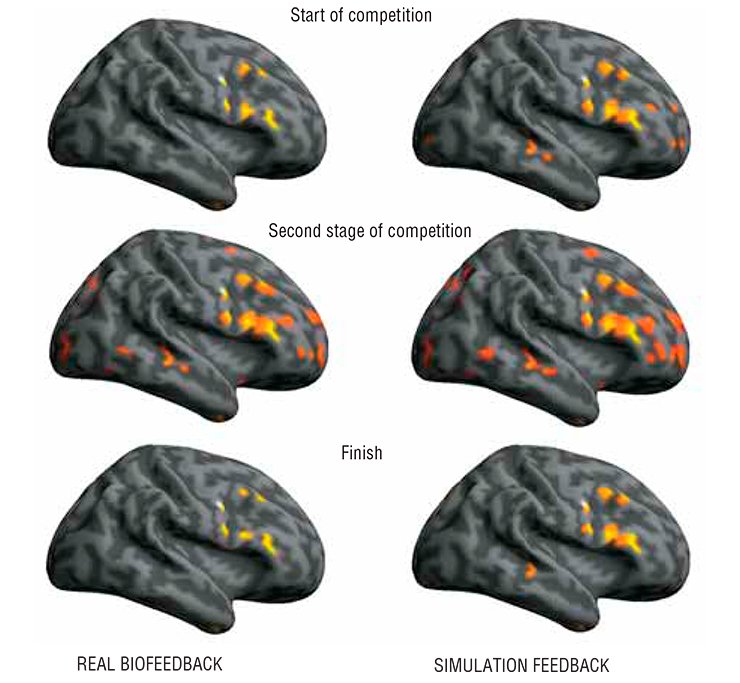 Vira!: In the modes of real and “false” (simulation) biofeedbacks aimed at the cognitive control of the pulse rate, the brain zone activation follows similar patterns although displays some minor differences. In particular, the brain activation zones are considerably enriched in the simulation biofeedback mode as compared with the real feedback mode, namely new neuronal ensembles appear in the cerebellum, fusiform gyrus, pons, stem structures, and some other brain areas. The maximal increase in the activation volume is observed during the second stage of game biofeedback, that is 8 to 12 minutes after involvement into a real or a false game plot. Then, as the game progresses these values decrease considerably. Although both biofeedback modes display similar qualitative patterns, their quantitative details differ considerably Vira!: In the modes of real and “false” (simulation) biofeedbacks aimed at the cognitive control of the pulse rate, the brain zone activation follows similar patterns although displays some minor differences. In particular, the brain activation zones are considerably enriched in the simulation biofeedback mode as compared with the real feedback mode, namely new neuronal ensembles appear in the cerebellum, fusiform gyrus, pons, stem structures, and some other brain areas. The maximal increase in the activation volume is observed during the second stage of game biofeedback, that is 8 to 12 minutes after involvement into a real or a false game plot. Then, as the game progresses these values decrease considerably. Although both biofeedback modes display similar qualitative patterns, their quantitative details differ considerably