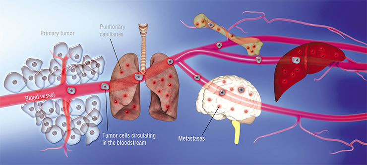 Some of the primary tumor cells enter the bloodstream or the lymph flow and travel along the vessels. Eventually, they are trapped in narrow capillaries in the organs, stick to their inner surface and enter the organ stroma from the vessels. Very few cancer cells survive this transition, however, those that do can form new growth sites, i.e. metastases. Based on: (Massagu, Obenauf, 2016) Some of the primary tumor cells enter the bloodstream or the lymph flow and travel along the vessels. Eventually, they are trapped in narrow capillaries in the organs, stick to their inner surface and enter the organ stroma from the vessels. Very few cancer cells survive this transition, however, those that do can form new growth sites, i.e. metastases. Based on: (Massagu, Obenauf, 2016)