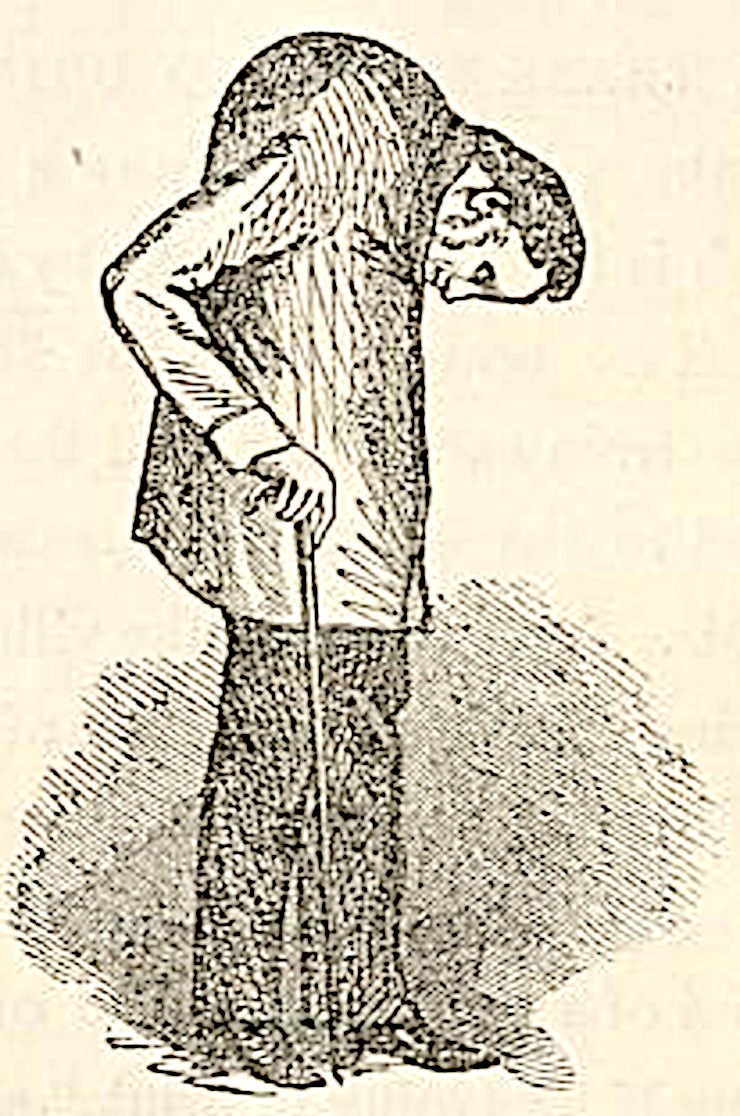 Анкилозирующий спондилит. Рис. Л. Траска, 1857 г.  Public Domain