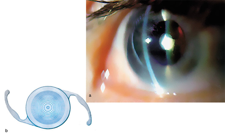 The surgery of cataract implies intraocular lens implantation. (a) An eye with anterior polar cataract and (b) a bifocal intraocular lens, developed at the Institute of Automatics and Electrometry, Siberian Branch of the Russian Academy of Sciences (Novosibirsk, Russia) The surgery of cataract implies intraocular lens implantation. (a) An eye with anterior polar cataract and (b) a bifocal intraocular lens, developed at the Institute of Automatics and Electrometry, Siberian Branch of the Russian Academy of Sciences (Novosibirsk, Russia)