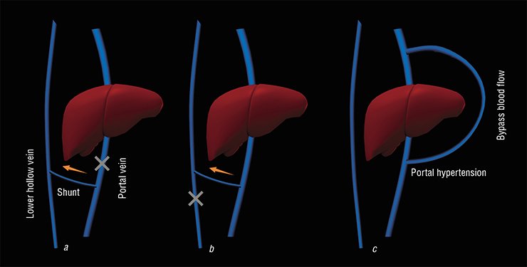 Normally, the blood from the portal vein, collecting the blood from the gastrointestinal tract, passes through the liver, where it is “purified” from toxins, to run to the lower hollow vein and eventually to the brain vessels. In order to lower portal hypertension and abdominal ascites, N. V. Eck directly connected the portal vein to lower hollow vein (side-to side or end-to side), directing all blood into the brain and bypassing the liver. (a) I. P. Pavlov designed a reverse shunt, which divides the portal blood flow between the hollow and portal veins. In this case, only part of “unpurified” blood bypasses the liver and penetrates into the central bloodstream, which prolongs the time of animals’ survival. Pavlov used both these models. (b) Natural liver shunt is depicted on the right panel. It may appear in the cirrhotic state as an adaptive response to portal vein hypertension. (c)
