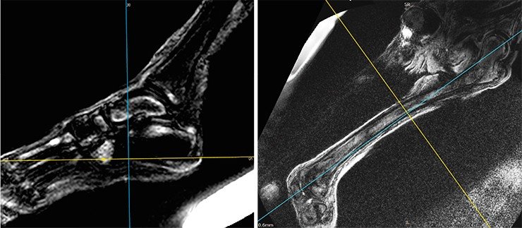 Tomograms of the bones and joints of the left leg – subchondral diffuse edematous erosive changes in the articular cartilage of the femoral head.The distal portion of the left femur diaphyseal cavity (right) shows edematous sclerotic lesions; in histological terms, these changes are the most consistent effects of sclerotic bone osteomyelitis after the process in the subacute or chronic phase.Changes in left knee MRI correspond to the degenerative and dystrophic changes with low-energy type of edema by osteoarthritis. The bones of the left foot (left) show pockets with peripheral edema and MR-dense (dark) central zones, interpreted previously as a manifestation of a cancer metastatic process (Letyagin et al., 2014) combined with degenerative and dystrophic changes, which can be considered osteoarthritis with low-energy swelling Tomograms of the bones and joints of the left leg – subchondral diffuse edematous erosive changes in the articular cartilage of the femoral head.The distal portion of the left femur diaphyseal cavity (right) shows edematous sclerotic lesions; in histological terms, these changes are the most consistent effects of sclerotic bone osteomyelitis after the process in the subacute or chronic phase.Changes in left knee MRI correspond to the degenerative and dystrophic changes with low-energy type of edema by osteoarthritis. The bones of the left foot (left) show pockets with peripheral edema and MR-dense (dark) central zones, interpreted previously as a manifestation of a cancer metastatic process (Letyagin et al., 2014) combined with degenerative and dystrophic changes, which can be considered osteoarthritis with low-energy swelling