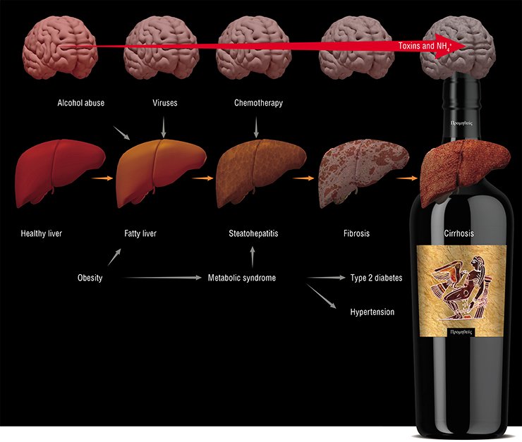 Multiple factors may underlie the development of hepatic encephalopathy. The liver can be directly “attacked” by viruses, alcohol, drugs, etc. Until recently, these factors were regarded as the major players in the progress of this disease. However, the latest data demonstrate that obesity, which spreads like an epidemic, also plays an important role in the development of cirrhosis as well as of type 2 diabetes and hypertension. Note that up to 60 % of patients with liver cirrhosis develop hepatic encephalopathy