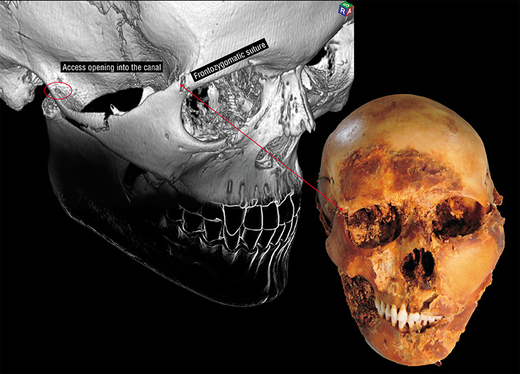 Trauma traces on the woman’s skull from mound 2: cranial asymmetry and damage to the right frontozygomatic suture. On the skull one can see some residual soft facial tissue (right). Left: The reconstructed 3D model of the skull shows a defect in the frontozygomatic suture and the opening into the drilled canal on the right zygomatic process