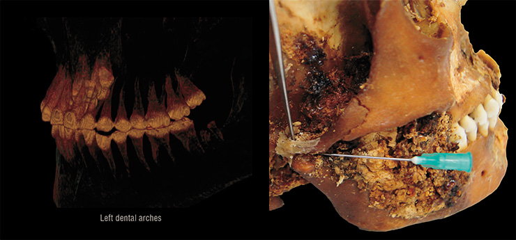 The dental arches on the damaged right side of the skull from mound 2 are well preserved while there is a crown fracture of the distal tooth in the lower row on the left side (left). The lower left dental arch also shows signs of complicated caries with inflammatory changes around the roots. All of this indicates prolonged, increased chewing loads on the left side of the jaw only. 3D reconstruction from CT images. Bougienage (“passage”) of the canals drilled during surgery in the woman’s skull from mound 2. The thin branch of the tweezers is inside the vertical canal in the right zygomatic process, and 