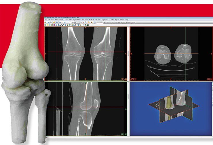 Preparation of the file for the additive manufacturing basing on the CT scan data can take up to one full day. During another day an anatomically precise pre-operative bone model can be manufactured in polymer (left). Shown images were treated using commercial software “Mimics” by Materialise Preparation of the file for the additive manufacturing basing on the CT scan data can take up to one full day. During another day an anatomically precise pre-operative bone model can be manufactured in polymer (left). Shown images were treated using commercial software “Mimics” by Materialise