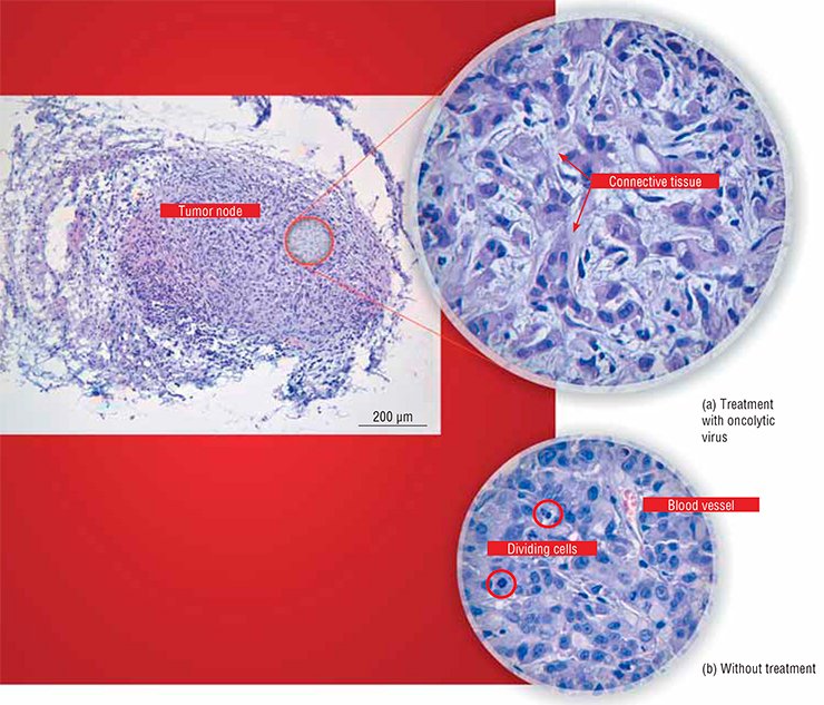 In the experiments conducted at Novosibirsk State University, Vector State Research Center of Virology and Biotechnology, and Institute of Chemical Biology and Fundamental Medicine (Siberian Branch, Russian Academy of Sciences), the nude mice with grafted human adenocarcinoma AsPc-1 were infected with the oncolytic Coxsackie B6 virus. (a) Morphological examination of tumor nodes shows that the number of tumor cells in node tissues decreases in the treated animals and that the connective tissue grows between the nodes. (b) In the untreated mice, the nodes are stuffed with actively divining tumor cells, while the connective tissue is absent. Courtesy of E. Ryabchikova (Institute of Chemical Biology and Fundamental Medicine)