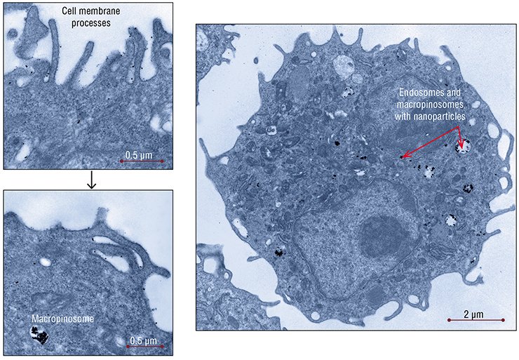 As early as 10 min after injection of gold nanoparticles into the mouse peritoneal cavity, about 80 % of the tumor cells of hepatoma A contained these particles: the cells were working literally as “wrung sponges” (right). Characteristic of these cells is macropinocytosis, a nonspecific way of taking up substances (left). Transmission electron microscopy As early as 10 min after injection of gold nanoparticles into the mouse peritoneal cavity, about 80 % of the tumor cells of hepatoma A contained these particles: the cells were working literally as “wrung sponges” (right). Characteristic of these cells is macropinocytosis, a nonspecific way of taking up substances (left). Transmission electron microscopy