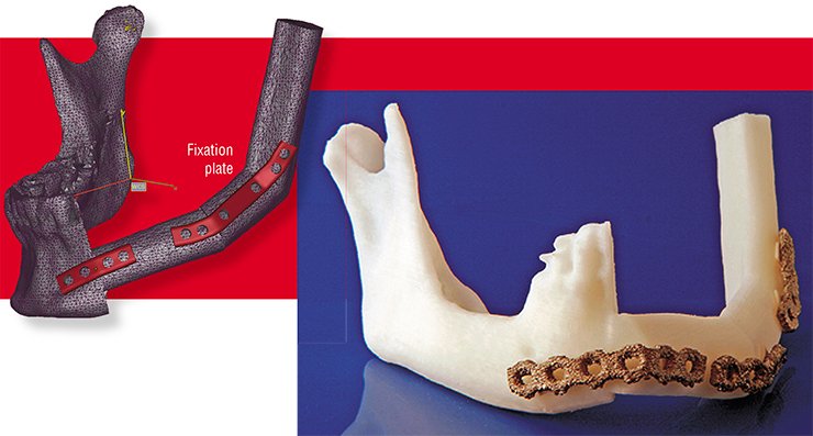 Today seven patients in Sweden have received individually fit implants and fixation plates made in the additive manufacturing laboratory at Mid Sweden University. The pictures above illustrate a complex medical case of the lower jaw bone reconstruction. The missing jaw bone fragments were replaced with sections of the patient’s fibula. Left: the CAD model of the bones and anatomically fitted fixation plates, with the surfaces approximated by a large number of flat polygons to provide faster data processing (so called polygonal approximation). Right: the plastic pre-operative model and the fixation plates made using AM technology from the medically approved aluminum-titanium-vanadium alloy Today seven patients in Sweden have received individually fit implants and fixation plates made in the additive manufacturing laboratory at Mid Sweden University. The pictures above illustrate a complex medical case of the lower jaw bone reconstruction. The missing jaw bone fragments were replaced with sections of the patient’s fibula. Left: the CAD model of the bones and anatomically fitted fixation plates, with the surfaces approximated by a large number of flat polygons to provide faster data processing (so called polygonal approximation). Right: the plastic pre-operative model and the fixation plates made using AM technology from the medically approved aluminum-titanium-vanadium alloy