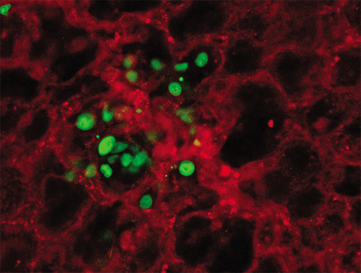 Cancer cells (stained green) leaving a blood vessel (stained red) and colonizing lung stroma. Multiphoton fluorescent microscopy. Microphotograph: A. M. Guiliani (Denmark) Cancer cells (stained green) leaving a blood vessel (stained red) and colonizing lung stroma. Multiphoton fluorescent microscopy. Microphotograph: A. M. Guiliani (Denmark)