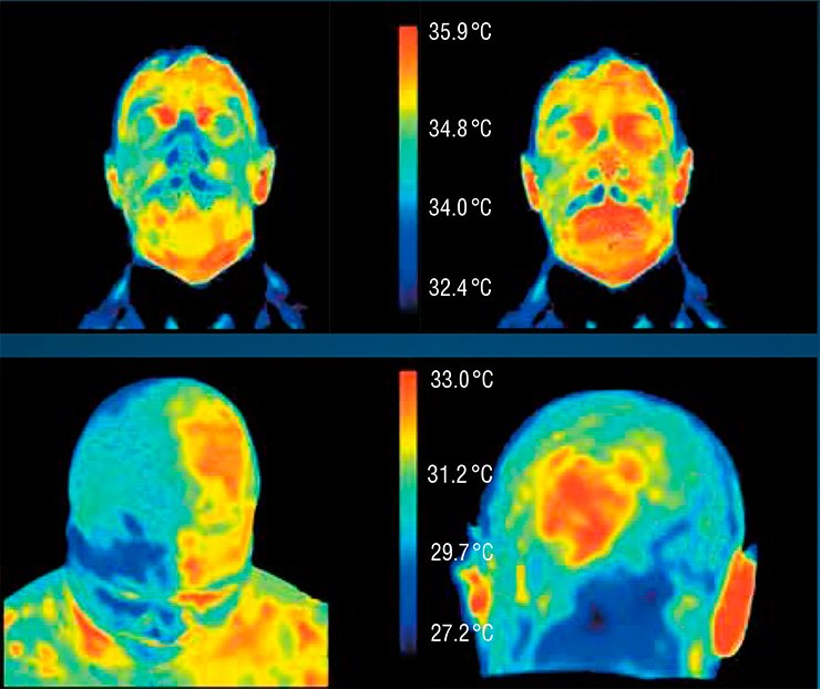 The increase in the temperature of the face of a healthy test person in five minutes after swallowing the “Yantar antitoks” (Amber antitox) biologically active additive (right) occurs owing to improvement of blood circulation. Malignant neoplasms are characterized by an elevated temperature; therefore, the face thermogram ensures localization of tumors in the cases of the Hodgkin’s disease (left) and meningioma (right) The increase in the temperature of the face of a healthy test person in five minutes after swallowing the “Yantar antitoks” (Amber antitox) biologically active additive (right) occurs owing to improvement of blood circulation. Malignant neoplasms are characterized by an elevated temperature; therefore, the face thermogram ensures localization of tumors in the cases of the Hodgkin’s disease (left) and meningioma (right)