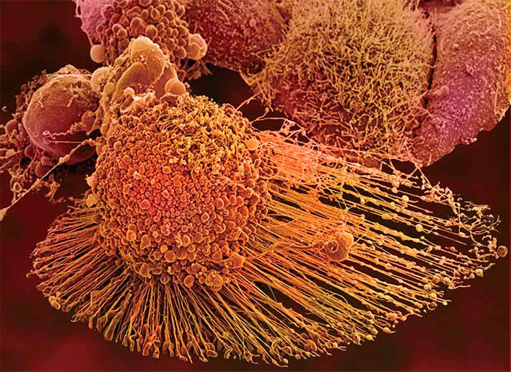 HeLa cell line is the most famous among all the lines continuously propagated under laboratory conditions. This line originated in 1951 from the cervical cancer cells harvested of Henrietta Lacks, who died in the same year. Since that time over 65,000 research papers on the studies of these cells have been published. Although the line itself is potentially immortal, apoptosis (programmed cell death) is initiated in aging or damaged cells. Vesicles, referred to as apoptotic bodies, develop on the surface of a dying cell (right). Electron microscopy. Photo by the courtesy of T. Deerinck and M. Ellisman, National Center for Microscopy and Imaging Research, University of California in San Diego (NCMIR/UCSD), United States HeLa cell line is the most famous among all the lines continuously propagated under laboratory conditions. This line originated in 1951 from the cervical cancer cells harvested of Henrietta Lacks, who died in the same year. Since that time over 65,000 research papers on the studies of these cells have been published. Although the line itself is potentially immortal, apoptosis (programmed cell death) is initiated in aging or damaged cells. Vesicles, referred to as apoptotic bodies, develop on the surface of a dying cell (right). Electron microscopy. Photo by the courtesy of T. Deerinck and M. Ellisman, National Center for Microscopy and Imaging Research, University of California in San Diego (NCMIR/UCSD), United States