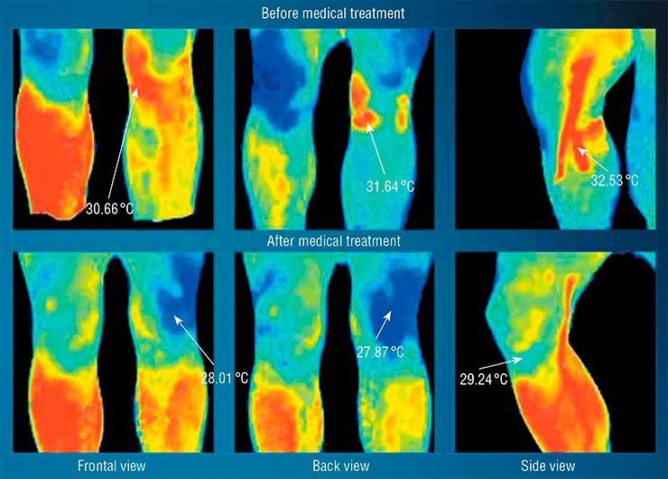 The thermogram helps the physician to control the process of healing of the injury of the left knee The thermogram helps the physician to control the process of healing of the injury of the left knee