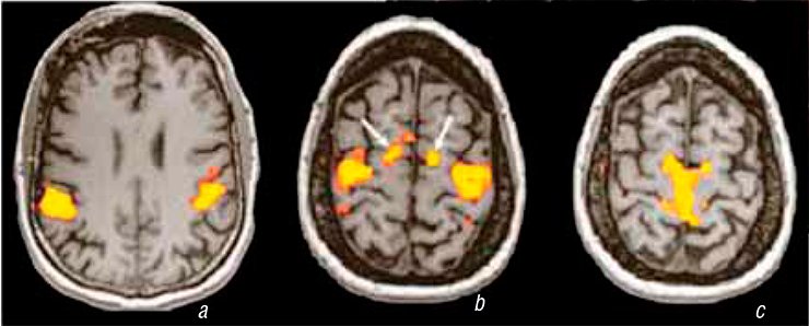Various cognitive and motor operations are accompanied by the activation of different brain zones. Right: The patterns of activation zones in the motor areas along the central brain fissure when a person is (a) saying a tongue twister, (b) successively tapping their fingers, and (c) flexing and stretching their legs. (Leach and Holland, 2010) Various cognitive and motor operations are accompanied by the activation of different brain zones. Right: The patterns of activation zones in the motor areas along the central brain fissure when a person is (a) saying a tongue twister, (b) successively tapping their fingers, and (c) flexing and stretching their legs. (Leach and Holland, 2010)