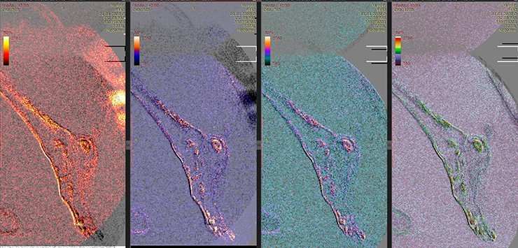 The bones of the left foot have pockets, which we previously interpreted as a manifestation of a cancer metastatic process. The centers are marked with pseudocolor mapping of MRI signal intensity The bones of the left foot have pockets, which we previously interpreted as a manifestation of a cancer metastatic process. The centers are marked with pseudocolor mapping of MRI signal intensity