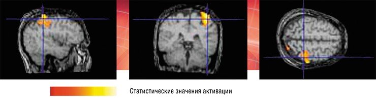 Стандартный эксперимент функциональной магнитно-резонансной томографии по визуализации когнитивных и двигательных операций («парадигм») состоит из нескольких блоков, каждый из которых включает фазу покоя и фазу активации. Так как время запаздывания сосудистого отклика измеряется несколькими секундами, длительность каждой фазы должна составлять 20—30 с. Оптимальная чувствительность метода достигается в том случае, если сигнал BOLD находится в состоянии динамического равновесия. Вверху – три ортогональных сечения трехмерного Т1-взвешенного изображения мозга при сокращении правой кисти