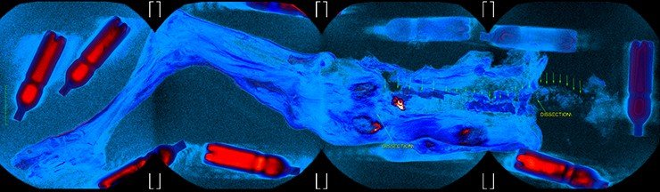 General view of the 3D conversion of MRIs. Pseudocolor mapping identifies locations with maximum liquid content. Imaging was performed in a 4-stations mode – you can see the zones of virtual "crosslinking" tomograms (each field of view is 48 cm) General view of the 3D conversion of MRIs. Pseudocolor mapping identifies locations with maximum liquid content. Imaging was performed in a 4-stations mode – you can see the zones of virtual "crosslinking" tomograms (each field of view is 48 cm)