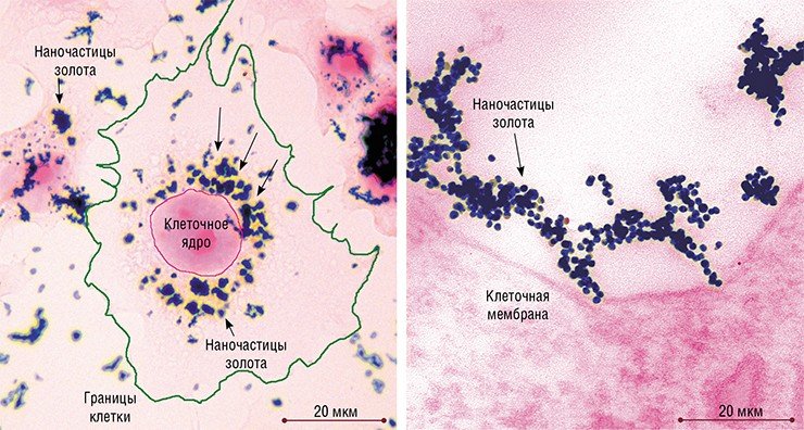 Слева: в этой клетке клеточной культуры HeLa, растущей на стекле, идет процесс поглощения наночастиц золота и накопление их в цитоплазме клеток. Световая микроскопия, окраска эозином. Справа: При 10°С – температуре, блокирующей процессы поступления веществ в клетку, наночастицы золота быстро собираются в рыхлые ассоциаты размером до 2,5 мкм. Причудливые фигуры из тысяч наночастиц контактируют с плазматической мембраной клетки