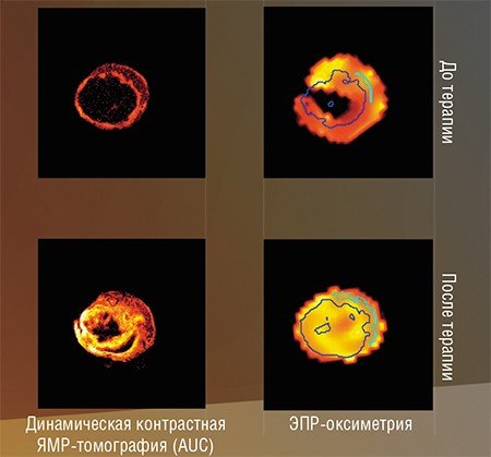 В Университете Чикаго были проведены сравнительные исследования насыщенности кислородом биологических тканей с помощью традиционных методов ядерного магнитного резонанса и новым методом ЭПР-оксиметрии, основанном на использовании тритильного радикала. Вверху – измеренные разными методами наиболее информативные сечения трехмерных образов распределения концентрации кислорода в области простаты у больных раком лабораторных мышей, показывающие эффективность комплексной генно-радиационной терапии