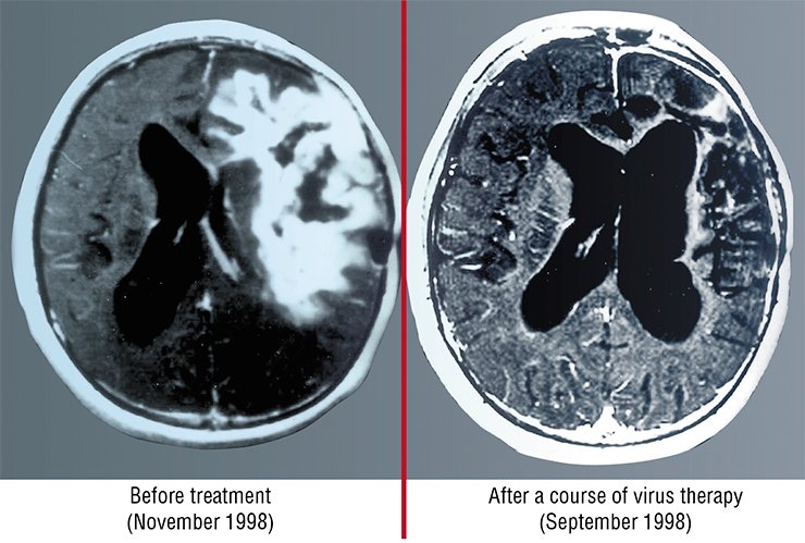 These tomograms demonstrate one of the most astonishing cases of recovery from cancer with the help of virus therapy, reported by the Journal of American Medical Association (JAMA) in 1999. The patient was a boy of 15 with glioblastoma, the most dangerous and rapidly developing brain tumor. The therapy with Newcastle disease virus was used, since the tumor occupied a considerable part of the brain and no other therapeutic intervention was applicable. According to oral communication of one of the authors, this patient is still alive and successfully works. (Csataryand, Bakacs, 1999)