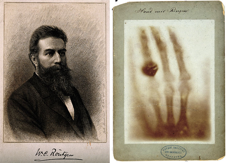 The discoverer of radioactivity Wilhelm von Röntgen (above) and a photo print of his 1985 radiograph, which shows finger bones with a ring on one of the fingers (right). Collection gallery. © CC BY 4.0 The discoverer of radioactivity Wilhelm von Röntgen (above) and a photo print of his 1985 radiograph, which shows finger bones with a ring on one of the fingers (right). Collection gallery. © CC BY 4.0