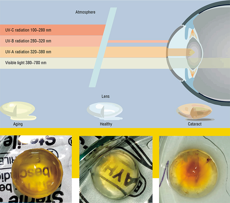 In the course of a person’s life, numerous hazardous factors affect the lens; the primary culprit here is the UV radiation of the Sun, which triggers photochemical reactions that damage the structure of proteins. However, the lens has a multi-level system of defense. The first level is its UV filters, which absorb the bulk of the UV spectrum, transforming it into heat. Next come the antioxidants, especially the ascorbic acid and glutathione. Ascorbate prevents the formation of free radicals that can modify the proteins of the lens. If it fails, glutathione backs it up by restoring the radicals to their original form. With age, this system becomes weaker In the course of a person’s life, numerous hazardous factors affect the lens; the primary culprit here is the UV radiation of the Sun, which triggers photochemical reactions that damage the structure of proteins. However, the lens has a multi-level system of defense. The first level is its UV filters, which absorb the bulk of the UV spectrum, transforming it into heat. Next come the antioxidants, especially the ascorbic acid and glutathione. Ascorbate prevents the formation of free radicals that can modify the proteins of the lens. If it fails, glutathione backs it up by restoring the radicals to their original form. With age, this system becomes weaker