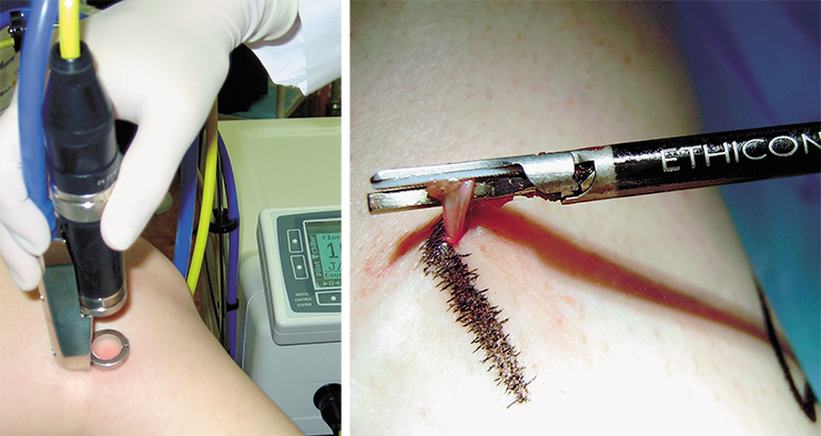 Today varicose veins are treated by various methods. Minimally invasive surgical removal of veins with the help of an ultrasonic scalpel is performed through small incisions in the skin (right). The lumens of small veins can be healed nonsurgically, by laser radiation acting through the skin. At the Novosibirsk Center for New Medical Technologies, they use a special device designed at the Institute of Laser Physics, Siberian Branch of the Russian Academy of Sciences (left) Today varicose veins are treated by various methods. Minimally invasive surgical removal of veins with the help of an ultrasonic scalpel is performed through small incisions in the skin (right). The lumens of small veins can be healed nonsurgically, by laser radiation acting through the skin. At the Novosibirsk Center for New Medical Technologies, they use a special device designed at the Institute of Laser Physics, Siberian Branch of the Russian Academy of Sciences (left)