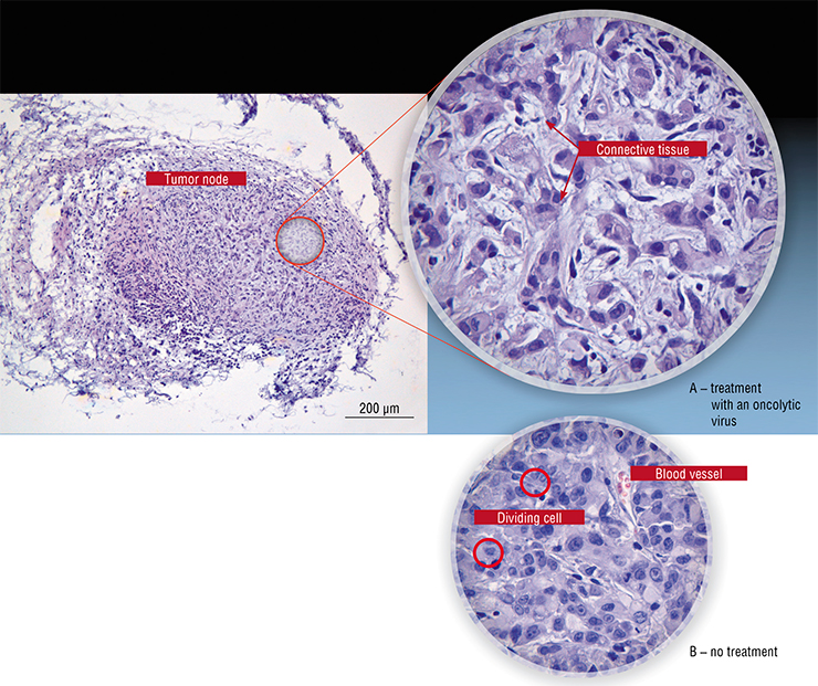 In the experiments carried out in the NSU, Vector, and ICBFM SB RAS, immunocompromised (“nude”) mice inoculated with the AsPC-1 human adenocarcinoma were infected with the Coxsackie B-6 oncolytic virus. Morphologic examination of the tumor nodes revealed a decrease in the number of tumor cells in mice receiving the treatment, with layers of connective tissue growing between cancer cells (A). In mice not receiving the treatment, the nodes were filled with actively developing tumor cells without any connective tissue (B). Photo: E. Ryabchikova (ICBFM SB RAS, Novosibirsk)