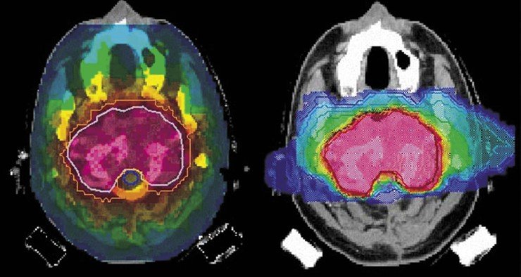 Computer plan of dose distribution obtained by using X-ray therapy from nine directions (left) and carbon therapy from two directions (right). One can see that the dose received by healthy tissues is much greater in the case of X-ray therapy as compared with ion therapy. A clearer contour of the high dose in the case of ion therapy shows a good therapeutic effect owing to fast recovery of the tumor-adjacent tissues
