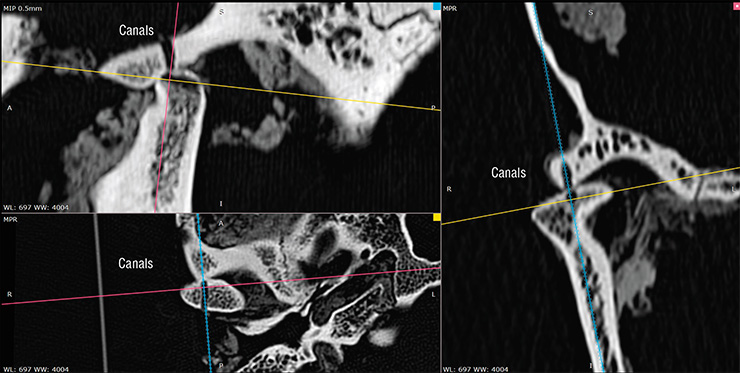 X-ray CT scans; colored lines run through the cavities of the drilled canals