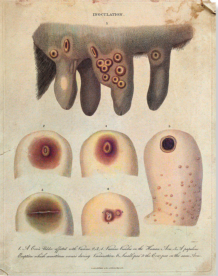 This color engraving shows skin lesions characteristic of orthopoxvirus infections. At the top is a cow’s udder with pustules typical of cowpox virus infection. Below is a human arm with cowpox and smallpox pustules. 1811. Engraving by J. Pass. Public Domain Mark/ Wellcome Collection
