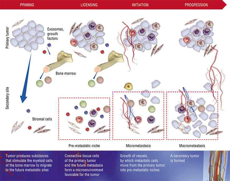 There are several stages in the formation of metastases. Priming – the education of the future secondary site with growth factors and exosomes, i.e. vesicles that deliver proteins and nucleic acids to cells, which are secreted by the tumor – from the earliest stage of the primary tumor growth. At the licensing stage, the primary tumor is immunosuppressed, and a favorable microenvironment is created in the pre-metastatic niches; at the initiation stage, tumor cells colonize the pre-metastatic niche; the final stage, called the progression stage, is when the secondary tumor is formed. Based on: (Liu,Cao, 2016) There are several stages in the formation of metastases. Priming – the education of the future secondary site with growth factors and exosomes, i.e. vesicles that deliver proteins and nucleic acids to cells, which are secreted by the tumor – from the earliest stage of the primary tumor growth. At the licensing stage, the primary tumor is immunosuppressed, and a favorable microenvironment is created in the pre-metastatic niches; at the initiation stage, tumor cells colonize the pre-metastatic niche; the final stage, called the progression stage, is when the secondary tumor is formed. Based on: (Liu,Cao, 2016)
