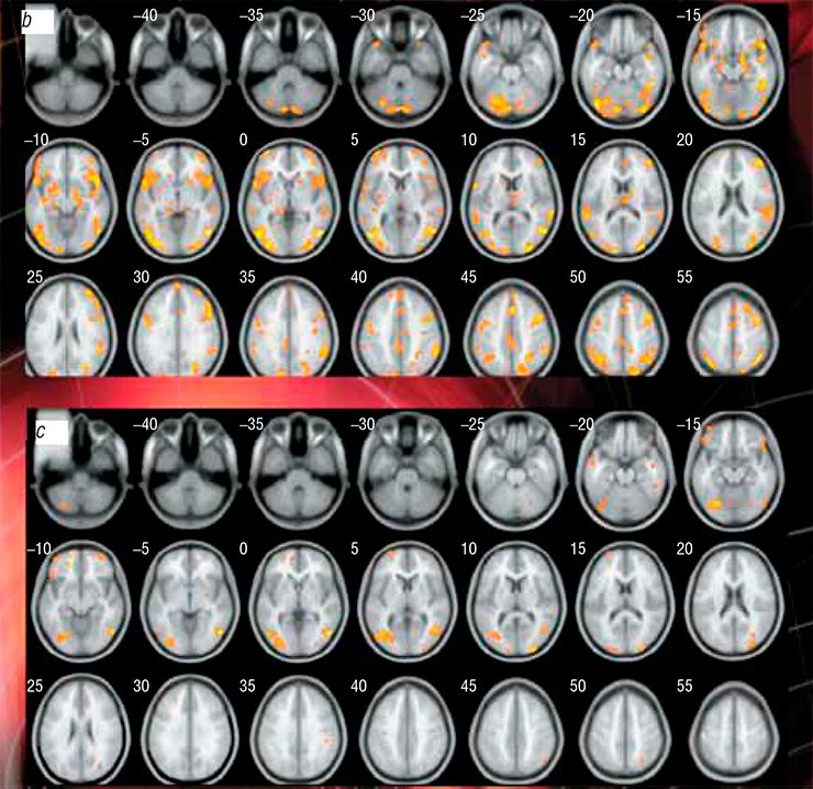 While the 16 players were playing Vira!, fMRI was used to study the emergence and development of their brain activity zones in. (b) At the “peak” of the competition (fourth—sixth attempts), an ever increasing number of newly formed neuronal ensembles are recruited into the struggle for the prize. New activity zones appear in the cortical, cerebellar, and stem structures as well as in the middle parietal and frontal gyri. (c) At the “finish”, the activation zones (of reduced sizes) are retained in the symmetrical posterior lobes of the cerebellum, pyramids, declive, middle frontal gyri, and occipital gyri While the 16 players were playing Vira!, fMRI was used to study the emergence and development of their brain activity zones in. (b) At the “peak” of the competition (fourth—sixth attempts), an ever increasing number of newly formed neuronal ensembles are recruited into the struggle for the prize. New activity zones appear in the cortical, cerebellar, and stem structures as well as in the middle parietal and frontal gyri. (c) At the “finish”, the activation zones (of reduced sizes) are retained in the symmetrical posterior lobes of the cerebellum, pyramids, declive, middle frontal gyri, and occipital gyri