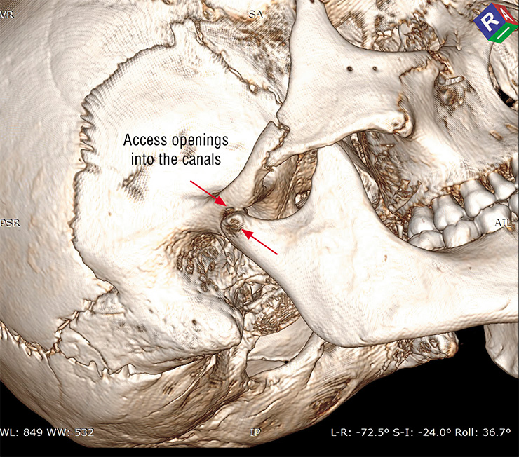 The reconstructed 3D model of the skull shows access openings into canals drilled in the skull found in Verkh-Kaldzhin 2 mound 2