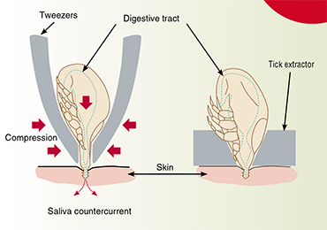 When you remove a sucking tick with tweezers, you must not squeeze it from the sides (left) so as not to cause a backflow of saliva from the tick under the host’s skin to avoid additional pathogen infection