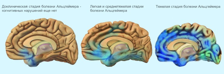 Распространение патологического процесса при болезни Альцгеймера. National Institute on Aging, NIH. Public Domain Распространение патологического процесса при болезни Альцгеймера. National Institute on Aging, NIH. Public Domain