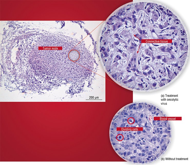 In the experiments conducted at Novosibirsk State University, Vector State Research Center of Virology and Biotechnology, and Institute of Chemical Biology and Fundamental Medicine (Siberian Branch, Russian Academy of Sciences), the nude mice with grafted human adenocarcinoma AsPc-1 were infected with the oncolytic Coxsackie B6 virus. (a) Morphological examination of tumor nodes shows that the number of tumor cells in node tissues decreases in the treated animals and that the connective tissue grows between the nodes. (b) In the untreated mice, the nodes are stuffed with actively divining tumor cells, while the connective tissue is absent. Courtesy of E. Ryabchikova (Institute of Chemical Biology and Fundamental Medicine)