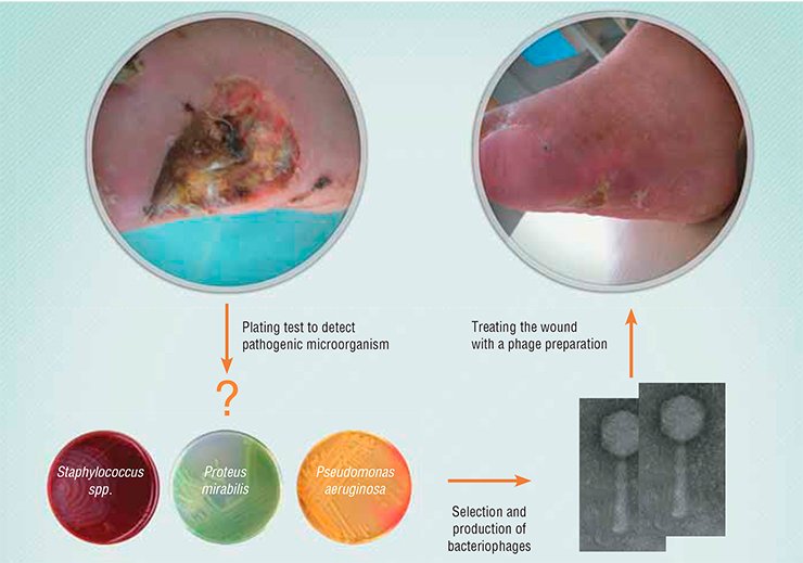 A Novosibirsk clinic is involved in experimental treatment of the diabetic foot, a severe complication of diabetes mellitus that may lead to gangrene, foot loss, and disability. Infection is one of the factors that cause this pathology.Phage therapy for the diabetic foot comprises (i) swabbing the wound in order to identify the involved pathogenic bacteria; (ii) screening the phage collection to find the phage capable of lysing the identified bacteria; and (iii) applying a sterile phage preparation to the wound. The treatment course takes about a week A Novosibirsk clinic is involved in experimental treatment of the diabetic foot, a severe complication of diabetes mellitus that may lead to gangrene, foot loss, and disability. Infection is one of the factors that cause this pathology.Phage therapy for the diabetic foot comprises (i) swabbing the wound in order to identify the involved pathogenic bacteria; (ii) screening the phage collection to find the phage capable of lysing the identified bacteria; and (iii) applying a sterile phage preparation to the wound. The treatment course takes about a week
