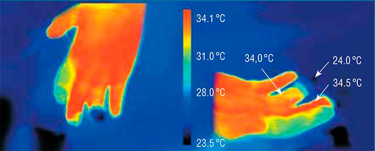 The necrosis of the ring-finger phalanx is evidenced by a lower temperature of the affected finger 