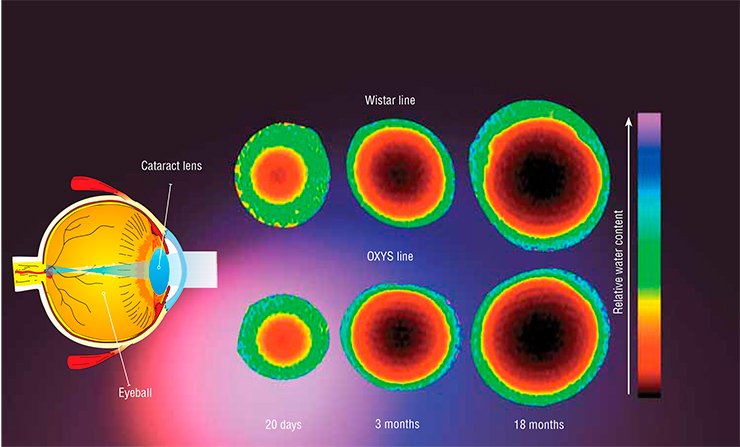 NMR visualization of the distribution of water in the eye lens of Wistar rats and the prematurely aging OXYS rats of different ages showed that the age-related changes in the lens, including cataract, are not attributed to the change in the content and diffusion of water molecules and other small molecules