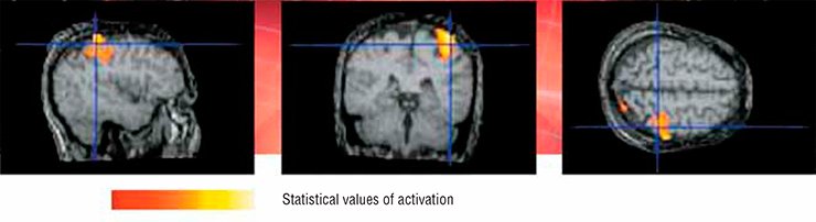 A standard experiment in functional MRI on visualization of cognitive and motor operations (paradigms) consists of several blocks, each comprising the rest and activation phases. Since the vascular response delay time falls in the range of several seconds, the duration of each phase should be 20 to 30 s. The optimal sensitivity of this method is attained when a BOLD signal is in dynamic equilibrium. Above: three orthogonal sections of a 3D T1-weighted image of the brain during the right hand contraction A standard experiment in functional MRI on visualization of cognitive and motor operations (paradigms) consists of several blocks, each comprising the rest and activation phases. Since the vascular response delay time falls in the range of several seconds, the duration of each phase should be 20 to 30 s. The optimal sensitivity of this method is attained when a BOLD signal is in dynamic equilibrium. Above: three orthogonal sections of a 3D T1-weighted image of the brain during the right hand contraction