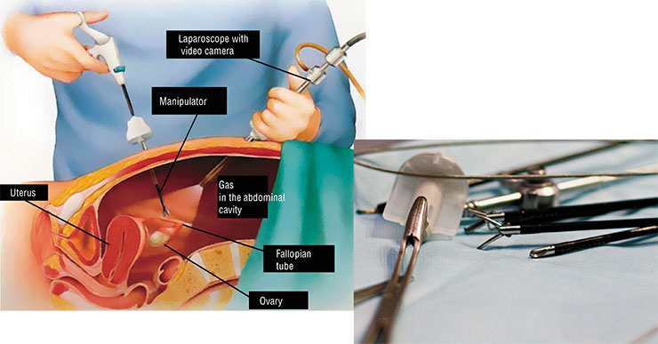 These unusual looking surgical tools are used for endoscopic surgery These unusual looking surgical tools are used for endoscopic surgery