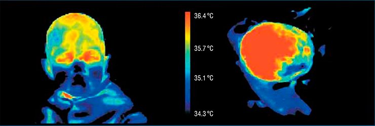 Being hit on his head from the left side, this patient had an injury on the right side. The bruise is seen in the thermograms of two projections of the patient’s head as lower temperature area. In this way, the injured area to be operated was determined 