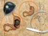Тяжелая ноша. Ожирение как медицинская проблема