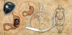 Тяжелая ноша. Ожирение как медицинская проблема