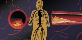 Много «доброго» холестерина – иногда плохая новость